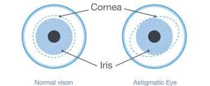 Astigmatism TE Koza Optom