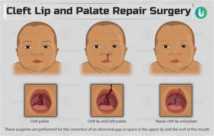 Cleft Palate Revision Surgery in India All That You Wanted to Know
