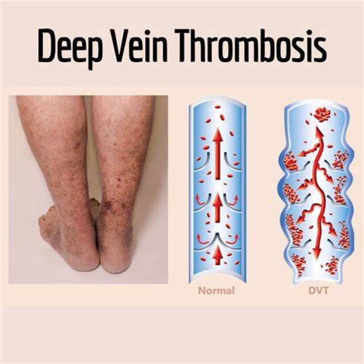 Deep vein thrombosis The Vein Lab