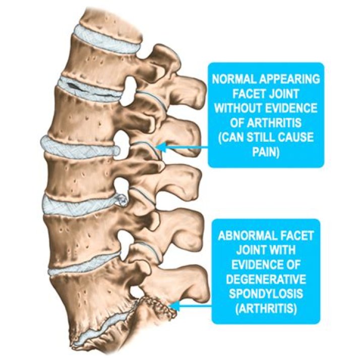Facet Arthropathy What Is It, Causes, Signs and Symptoms, and More