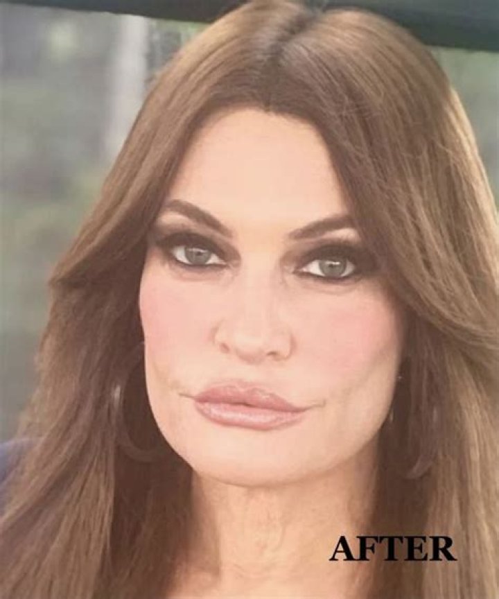Kimberly Guilfoyle Plastic Surgery Kimberly Guilfoyle Face Before And