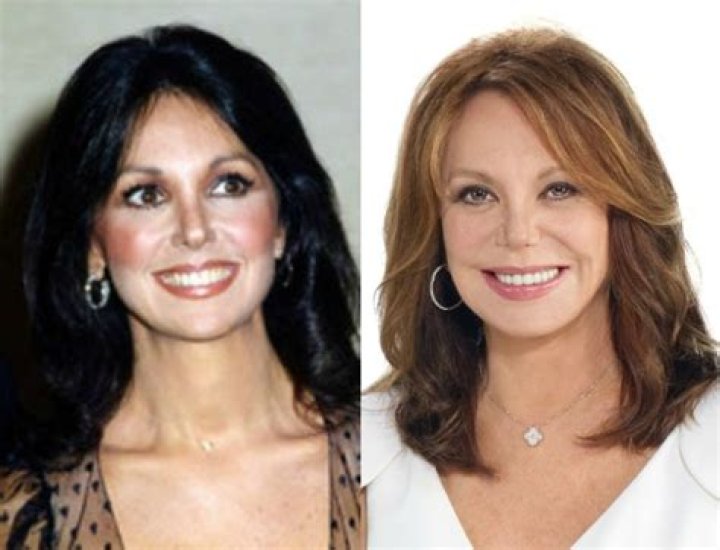 Marlo Thomas Plastic Surgery Before and After Photos Latest Plastic