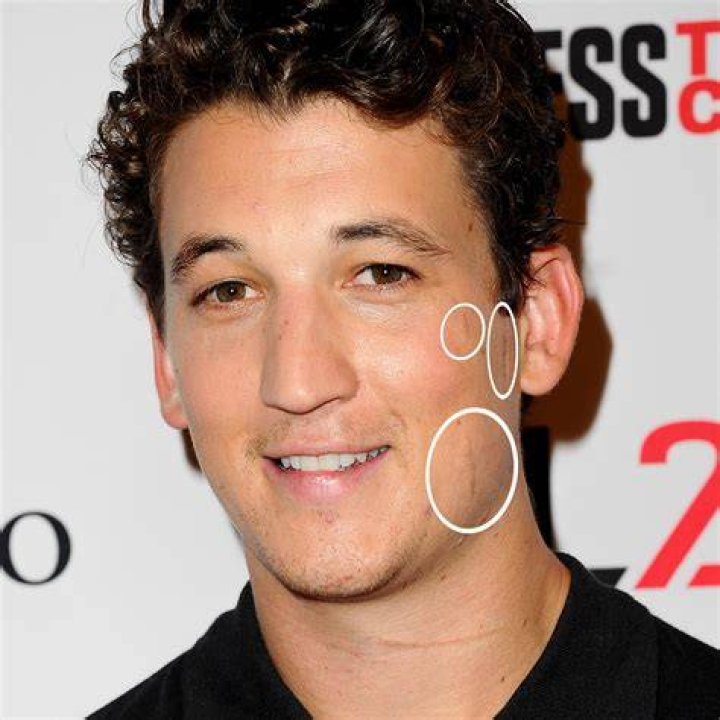 Miles Teller, Charlie Puth, and More Stars You Didn't Notice Have Scars
