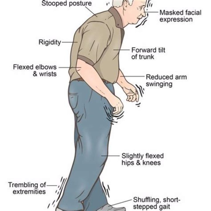Parkinson's Disease London Neurosurgery Partnership