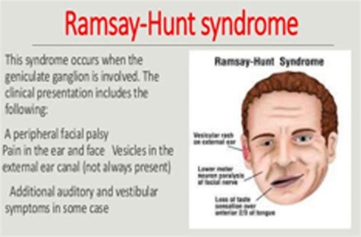 Ramsay Hunt Syndrome Causes, Symptoms, Recovery Time & Treatment