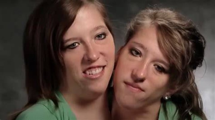 Rare Conjoined Twins Abby and Brittany Share Their Exciting News With