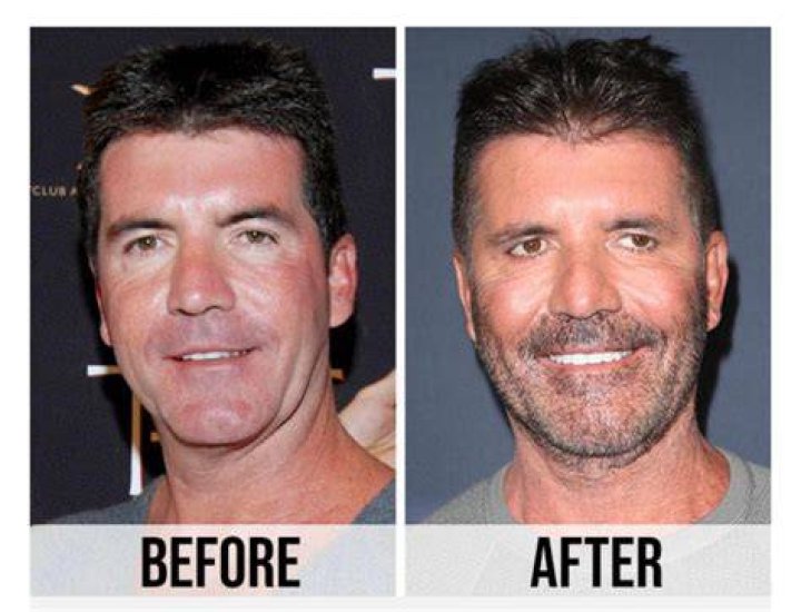 Simon Cowell undergoes surgery after breaking back while at home with
