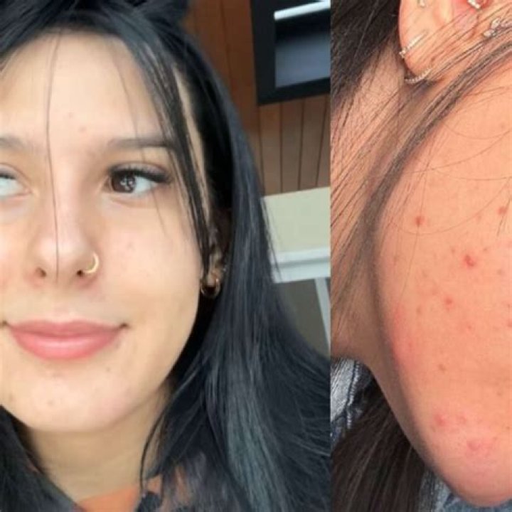 Tratamento contra acne e mutila&ccedil;&atilde;o genital A suposta castra&ccedil;&atilde;o qu&iacute;mica