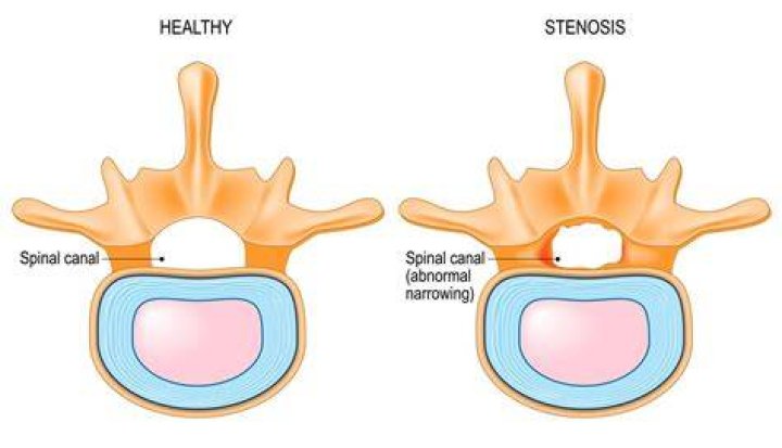 What Is Spinal Stenosis And How Can It Be Treated? Homewood